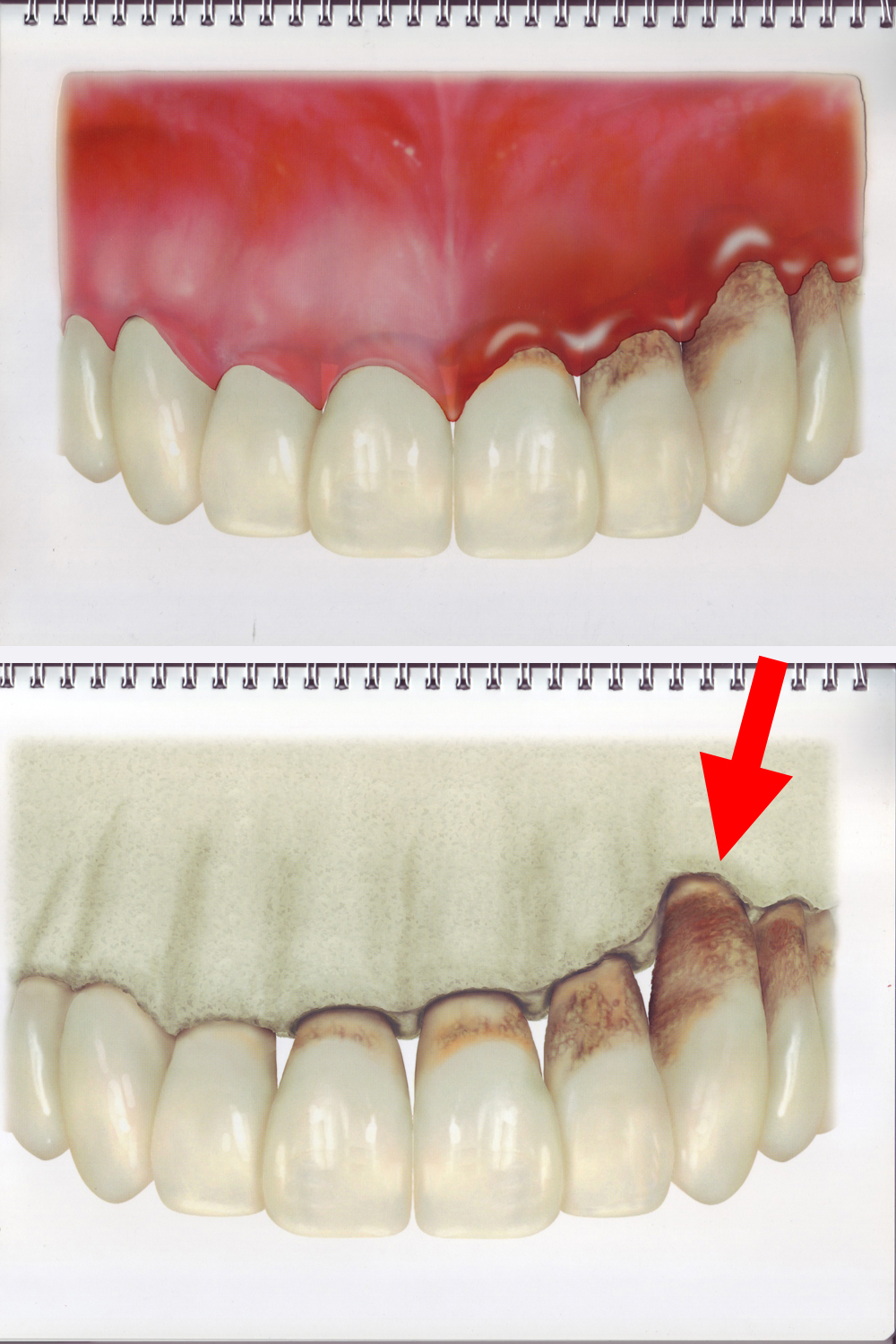 歯周病の進行度チェック